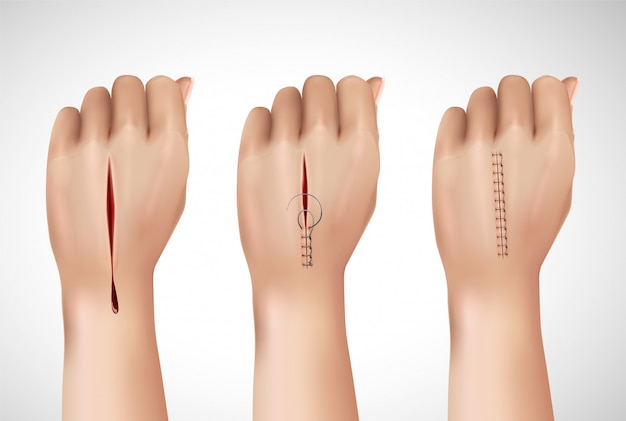 Alginate Dressing: A Game Changer in Absorbent Dressing