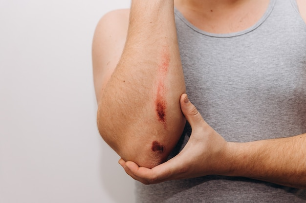 Should I Cover or Uncover My Wound to Heal Faster?